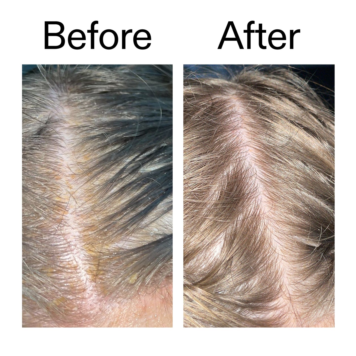 salicylic-acid-exfoliating-scalp-treatment-x4 Salicylic_Acid_Exfoliating_Scalp_Treatment_Before_After_2000x2000_e572a30f-057c-4a48-823b-1c09dc97f8d0.jpg