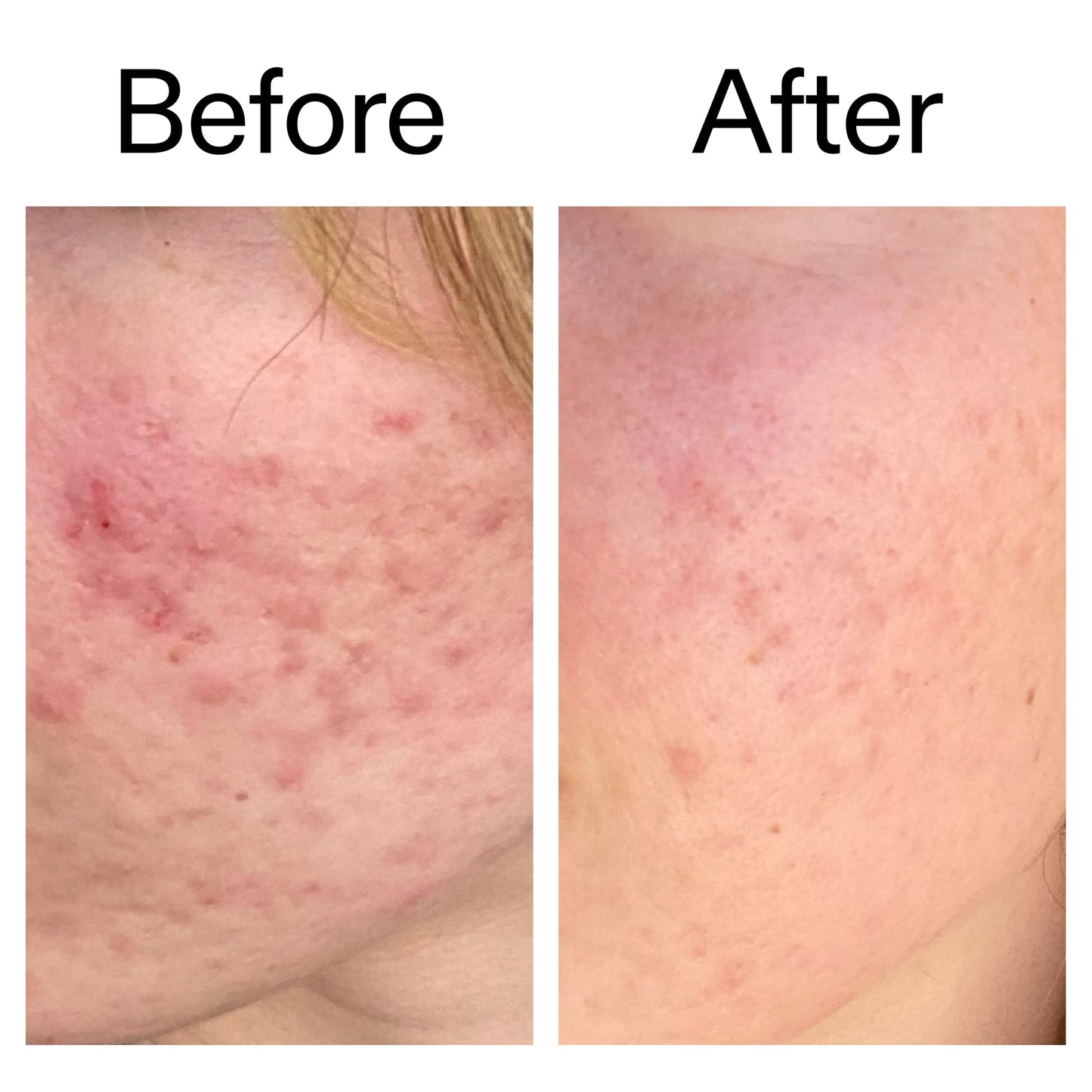 10-azelaic-acid-serum-for-redness-relief-b3 Azealic_Acid_Serum_B_A_Ppage_2000_x_2000.jpg