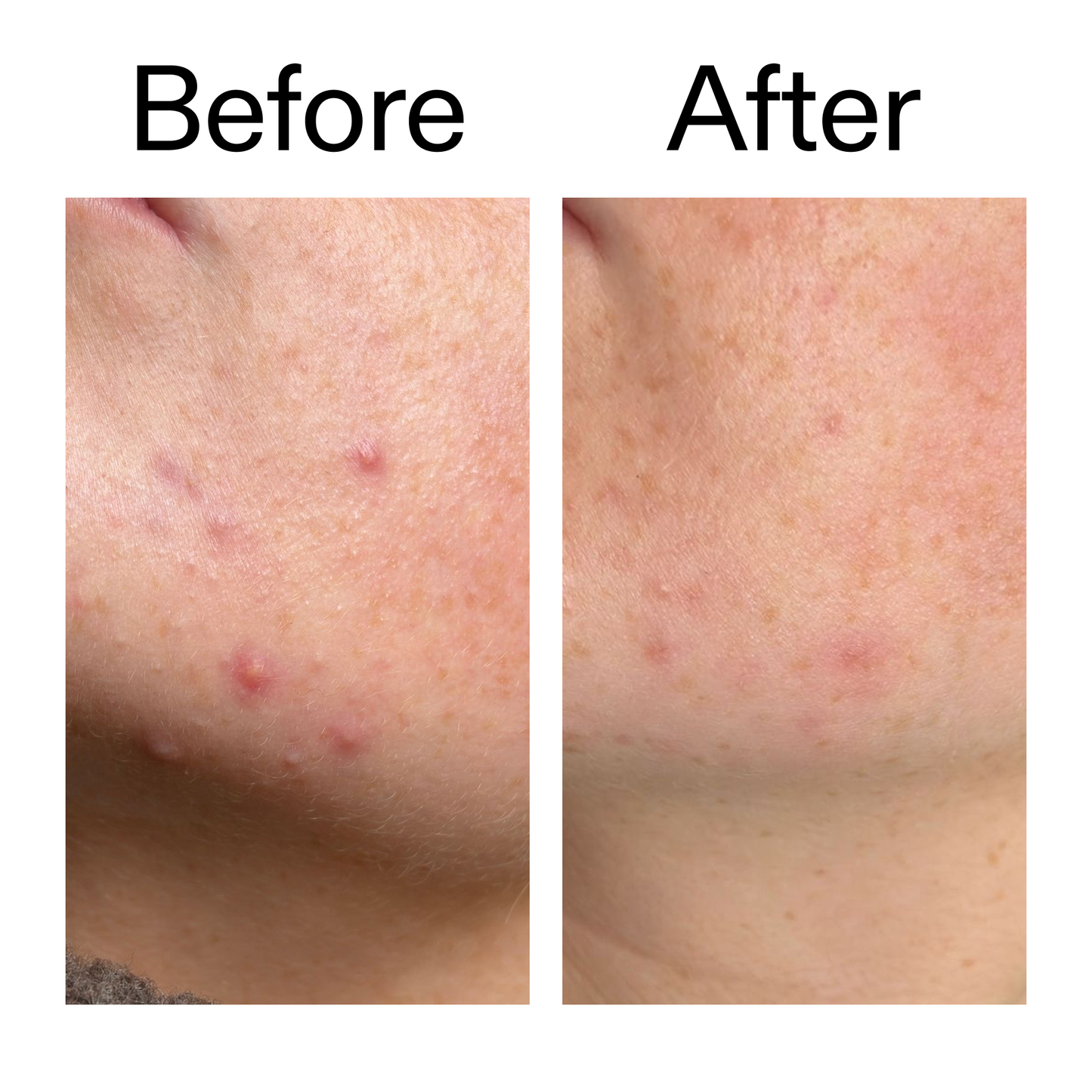 10-azelaic-acid-serum-for-redness-relief-b3 B_A_1_PPAGE.png
