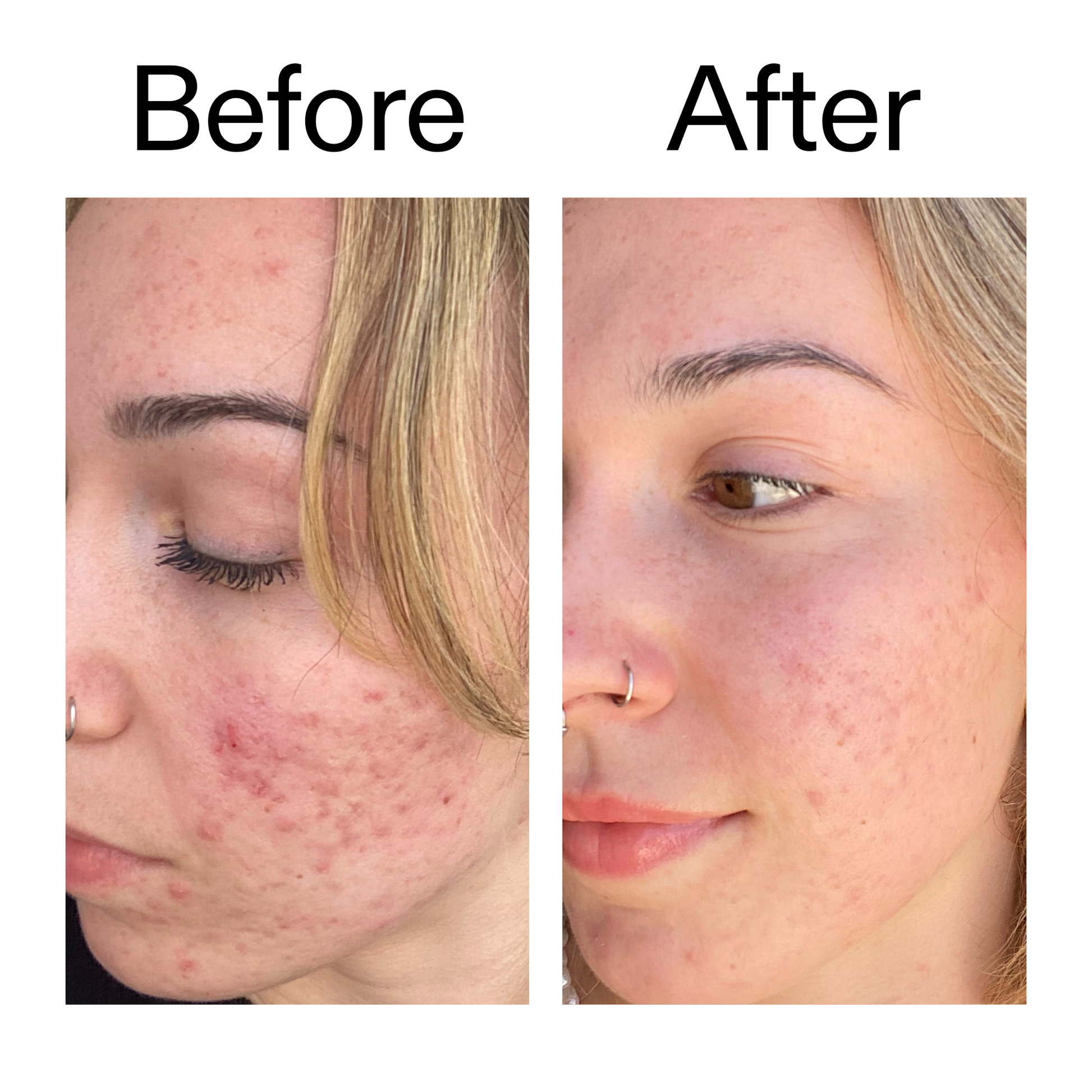 10-azelaic-acid-serum-for-redness-relief-b3 B_A_2_PPAGE.png