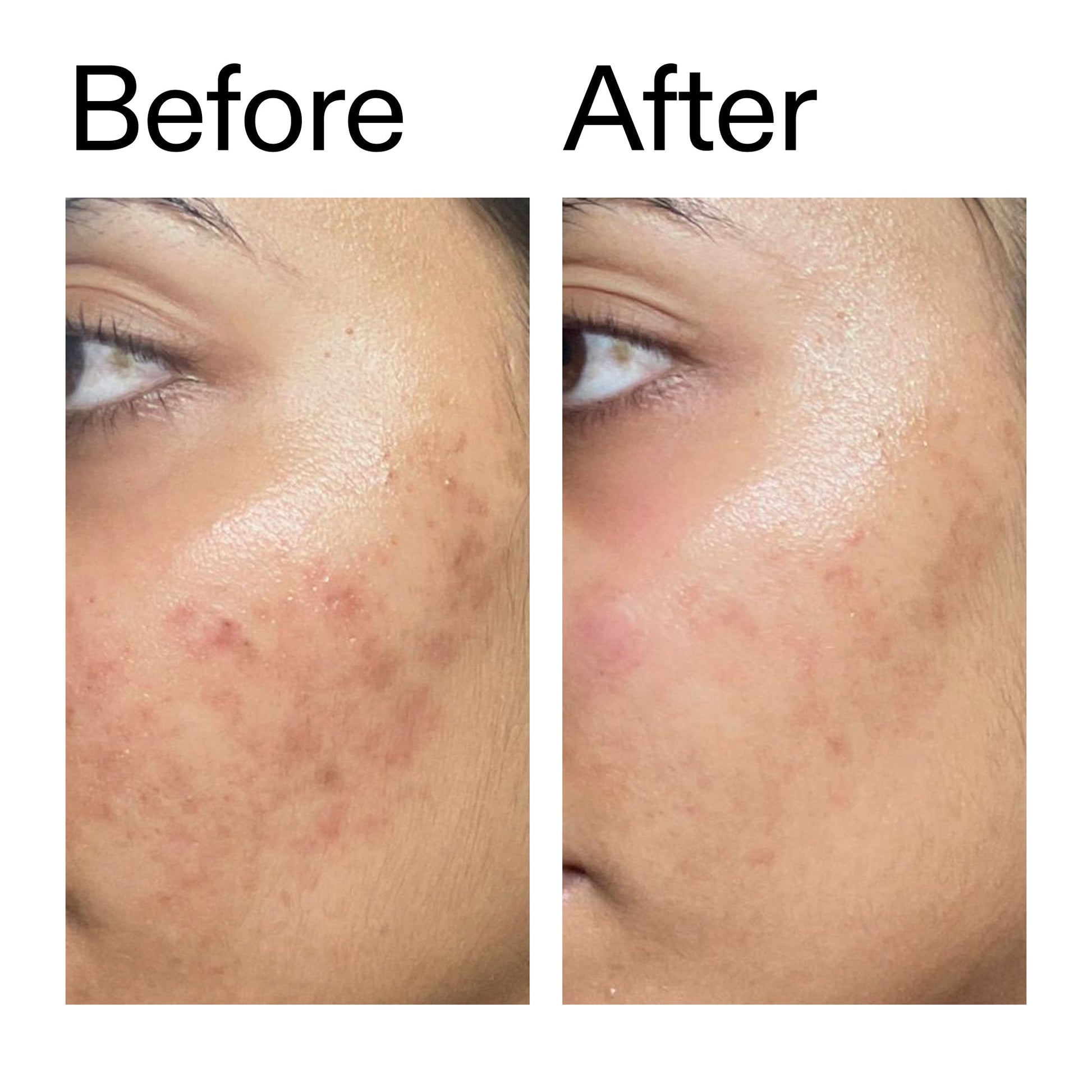 ectoin-hydro-barrier-serum-h0 Ectoin_Hydro-barrier_Serum__Before_After_2000x2000_34261920-d004-48d0-9c7b-8e1c15971bfd.jpg