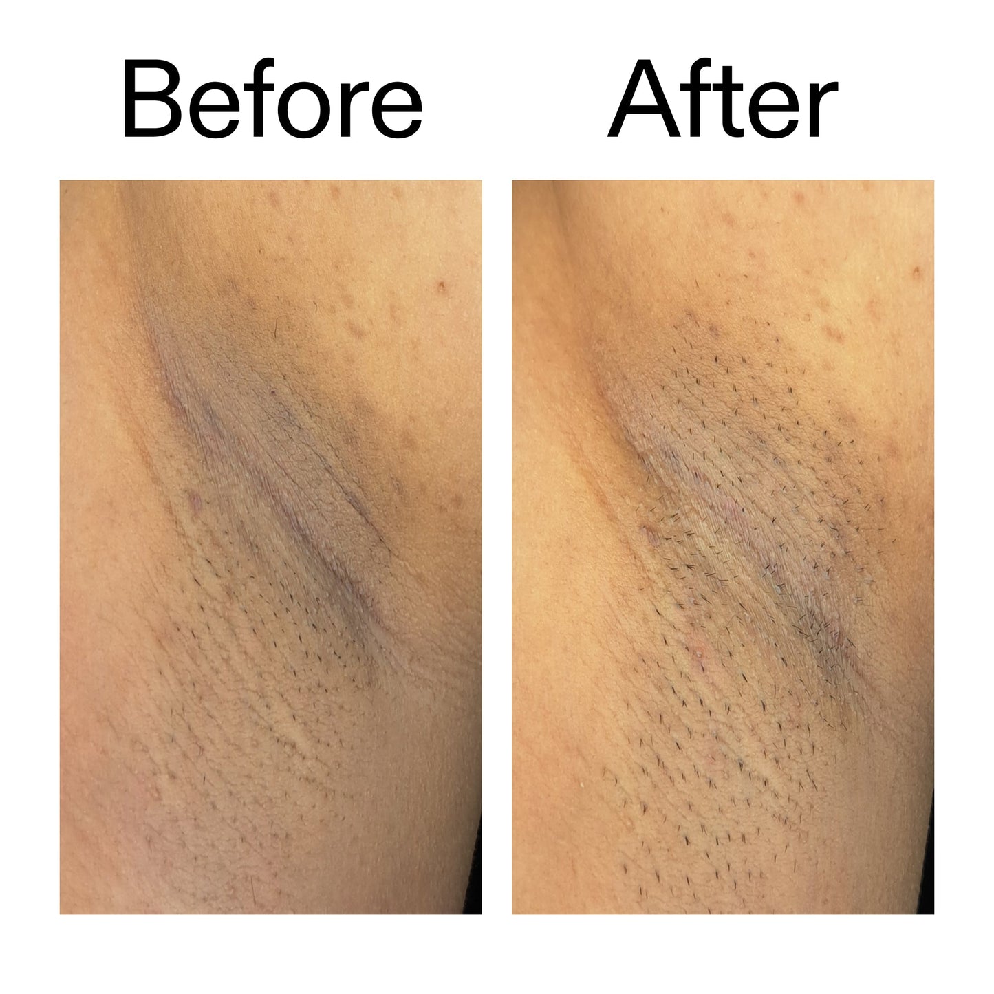 glycolic-acid-exfoliating-body-stick-o0 Glycolic_Acid_Exfoliating_Body_Stick_Before_After_V3_2000x2000_ea919cd9-1439-4a46-82a0-76200eb5bb42.jpg
