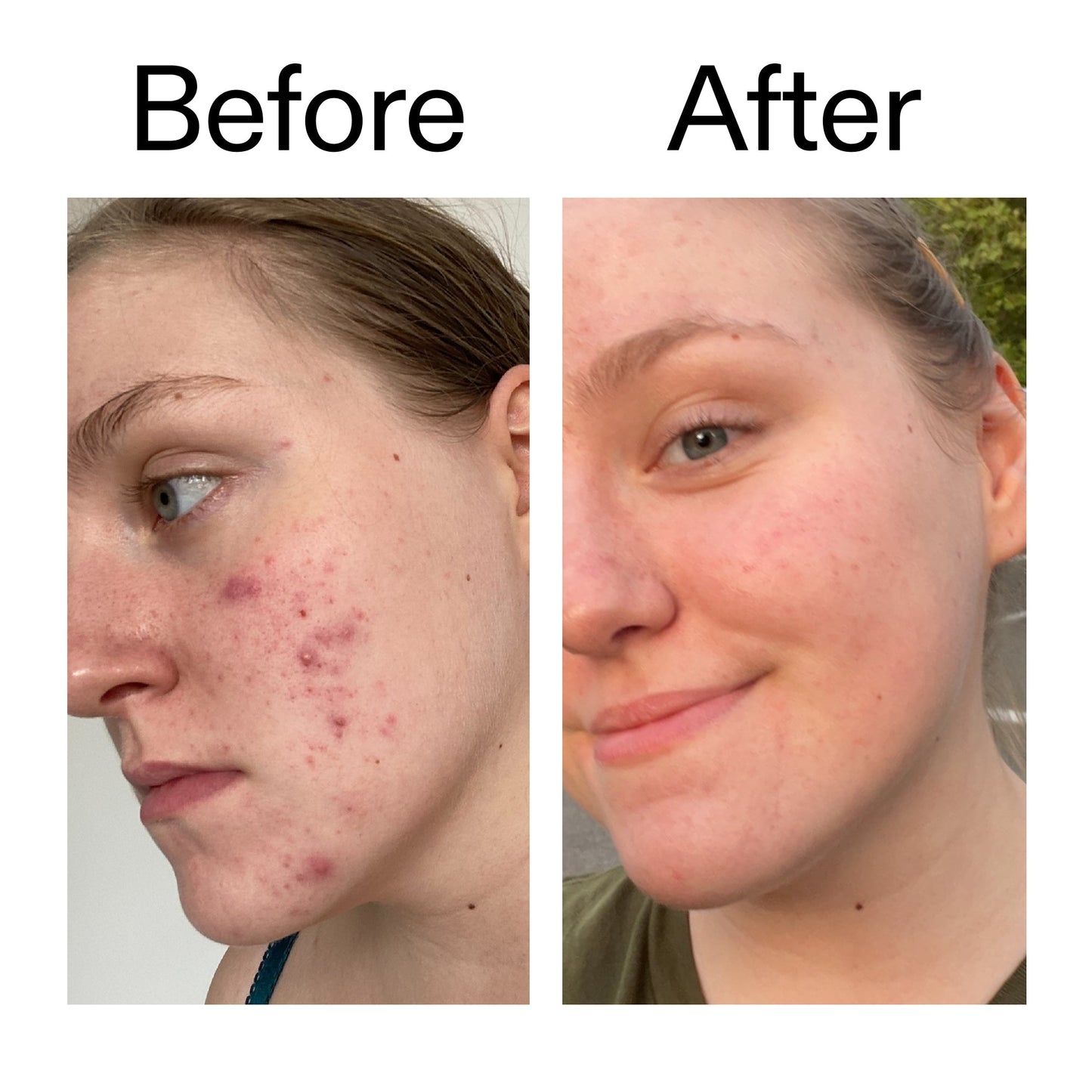 glycolic-acid-toner-n9 Glycolic_Acid_Toner_Before_After_2000x2000_49f0b9f7-e71b-4b2e-a8f8-2ea4b73247bb.jpg