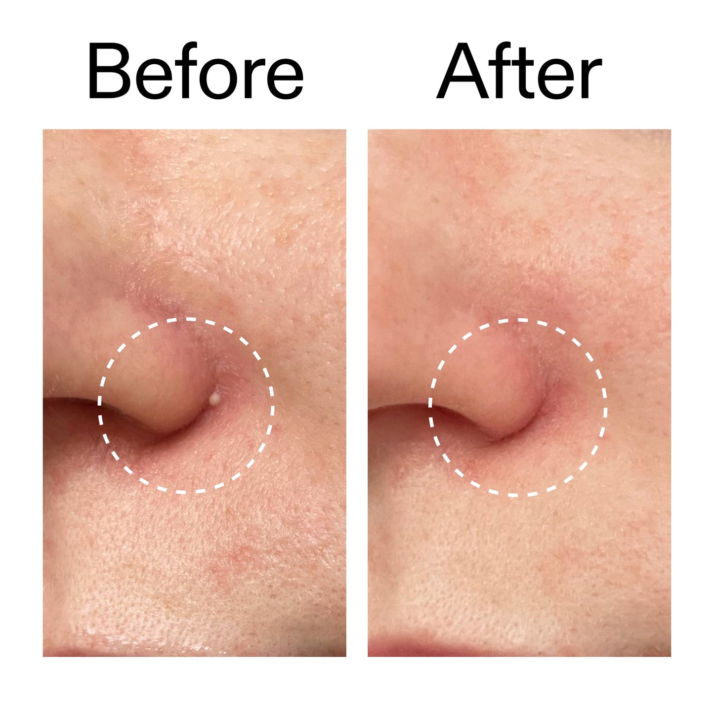 hydrocolloid-invisible-pimple-patches-pack-of-44-w0 Hydrocolloid_Invisible_Pimple_Patches_Before_After_2000x2000_b02aa37b-c78a-4682-91de-9135af5bb7df.jpg