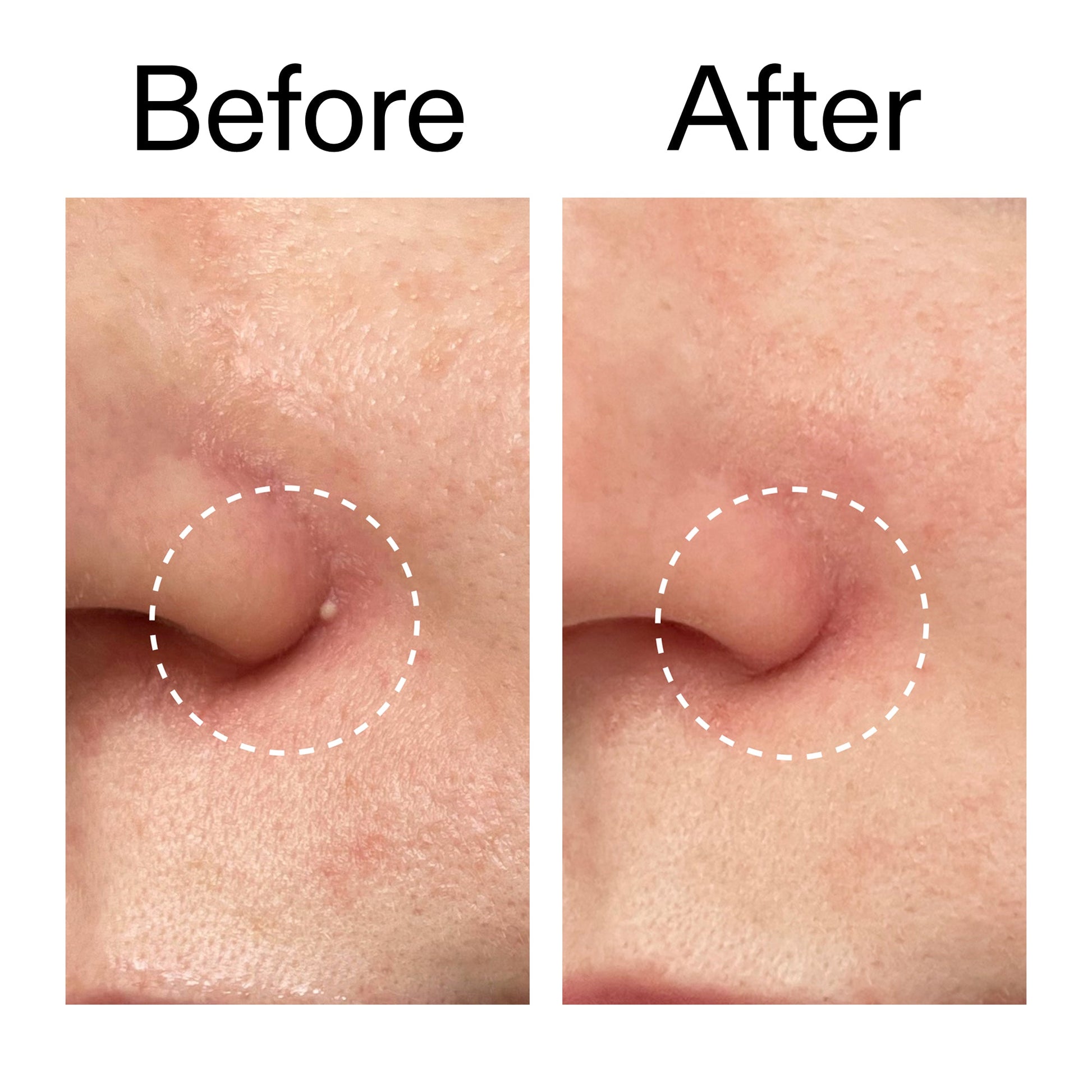 hydrocolloid-invisible-pimple-patches-pack-of-22-s7 Hydrocolloid_Invisible_Pimple_Patches_Before_After_2000x2000_b02aa37b-c78a-4682-91de-9135af5bb7df.jpg