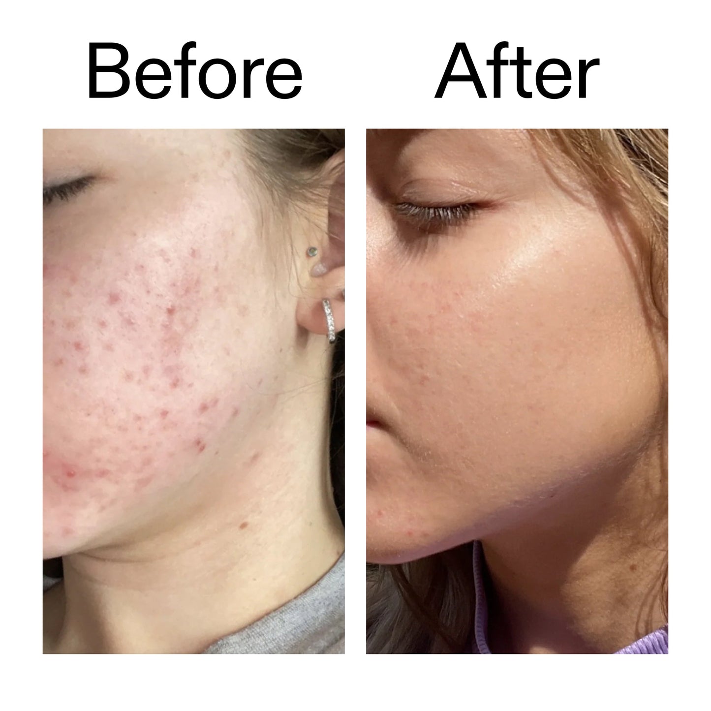 10-niacinamide-serum-duo-h0 Niacinamide_Serum_Before_After_2000x2000_bde32455-9e7d-448e-b053-bef41504f0a9.jpg