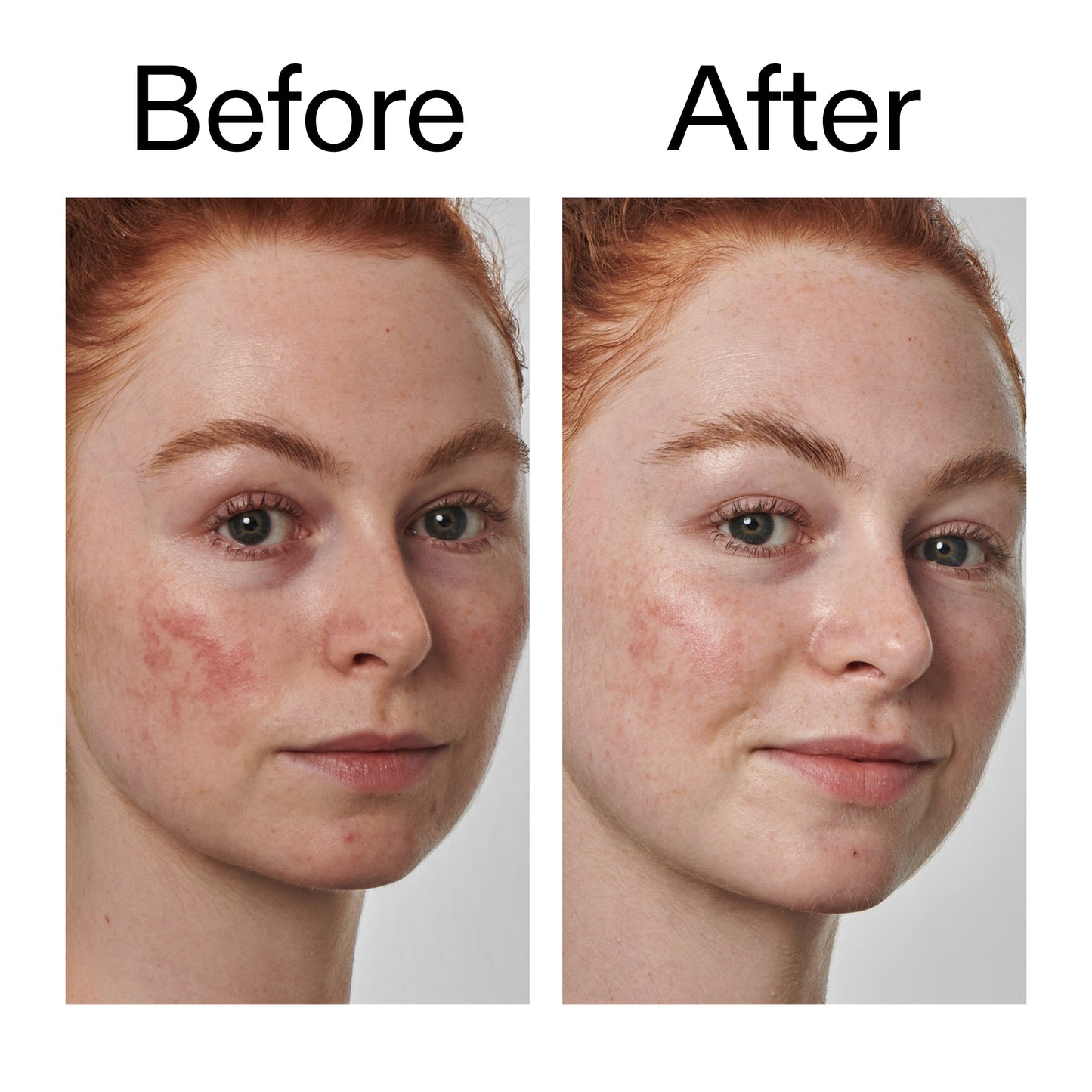 10-azelaic-acid-serum-for-redness-relief-b3 Redness_Relief_Serum_Before_After_2000x2000_3334dc9a-cce9-4e00-8aec-7ad89ca051f2.jpg
