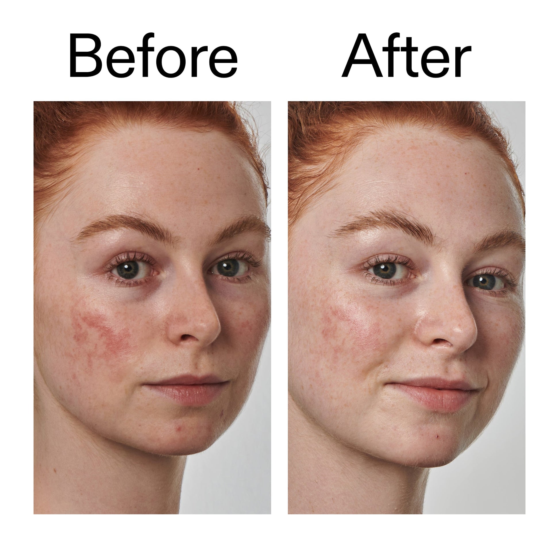 10-azelaic-acid-serum-for-redness-relief-b3 Redness_Relief_Serum_Before_After_2000x2000_3334dc9a-cce9-4e00-8aec-7ad89ca051f2.jpg