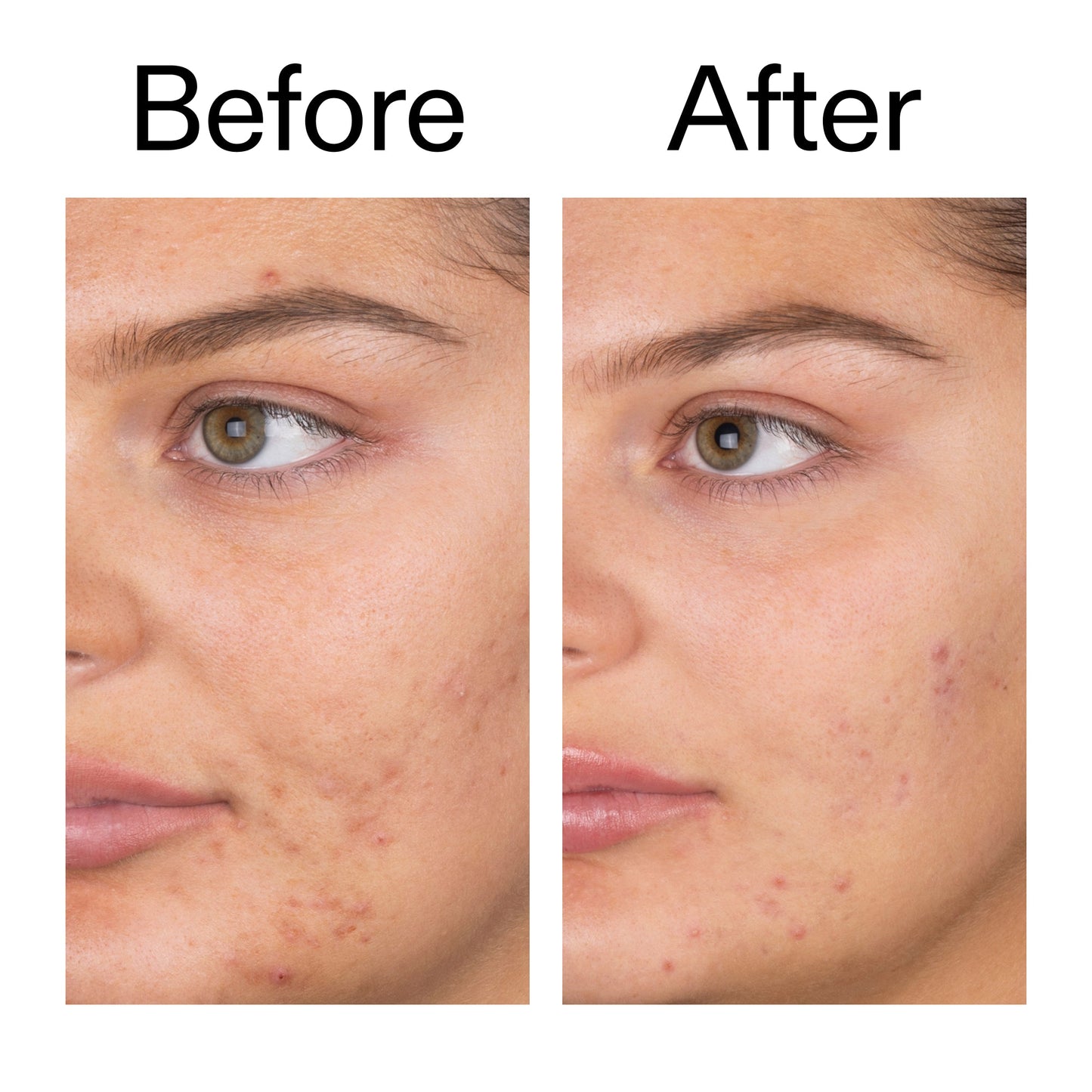 salicylic-acid-cleanser-150ml-o6 Salicylic_Acid_Cleanser_-_150ml_Before_After_2000x2000_e7230494-853f-4b07-82b1-27669104c995.jpg