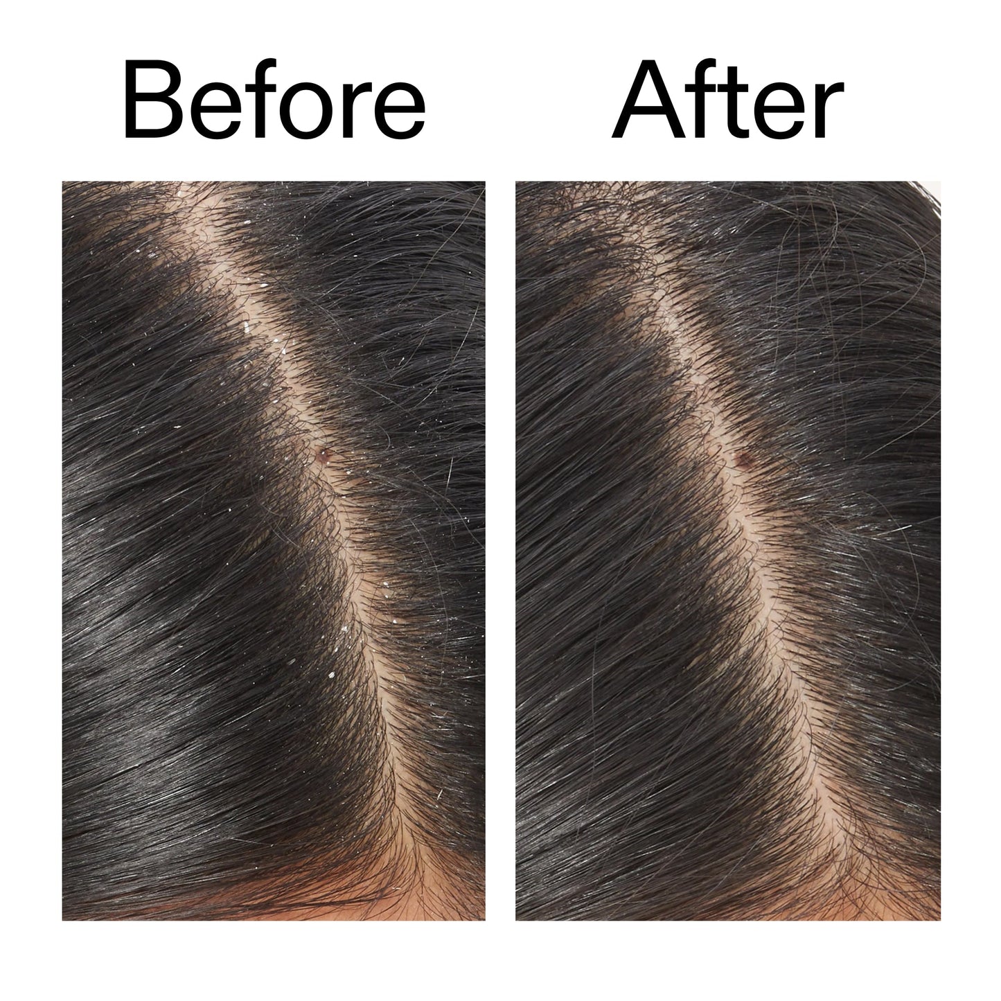 salicylic-acid-exfoliating-scalp-treatment-x4 Salicylic_Acid_Exfoliating_Scalp_Treatment_Before_After_V2_2000x2000_02bd61ad-42bf-490b-b3e3-7e04b2e8a673.jpg