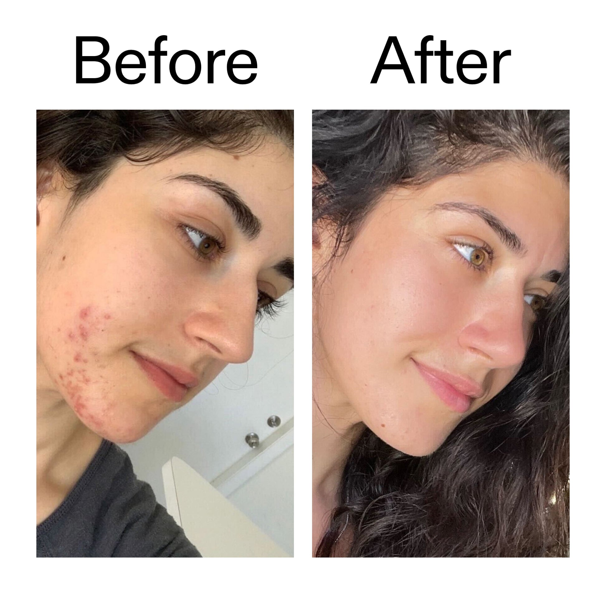 succinic-acid-acne-treatment-p8 Succinic_Acid_Treatment_Before_After_2000x2000_6a5f0054-2f58-4433-9314-0dc72c9bdd3b.jpg