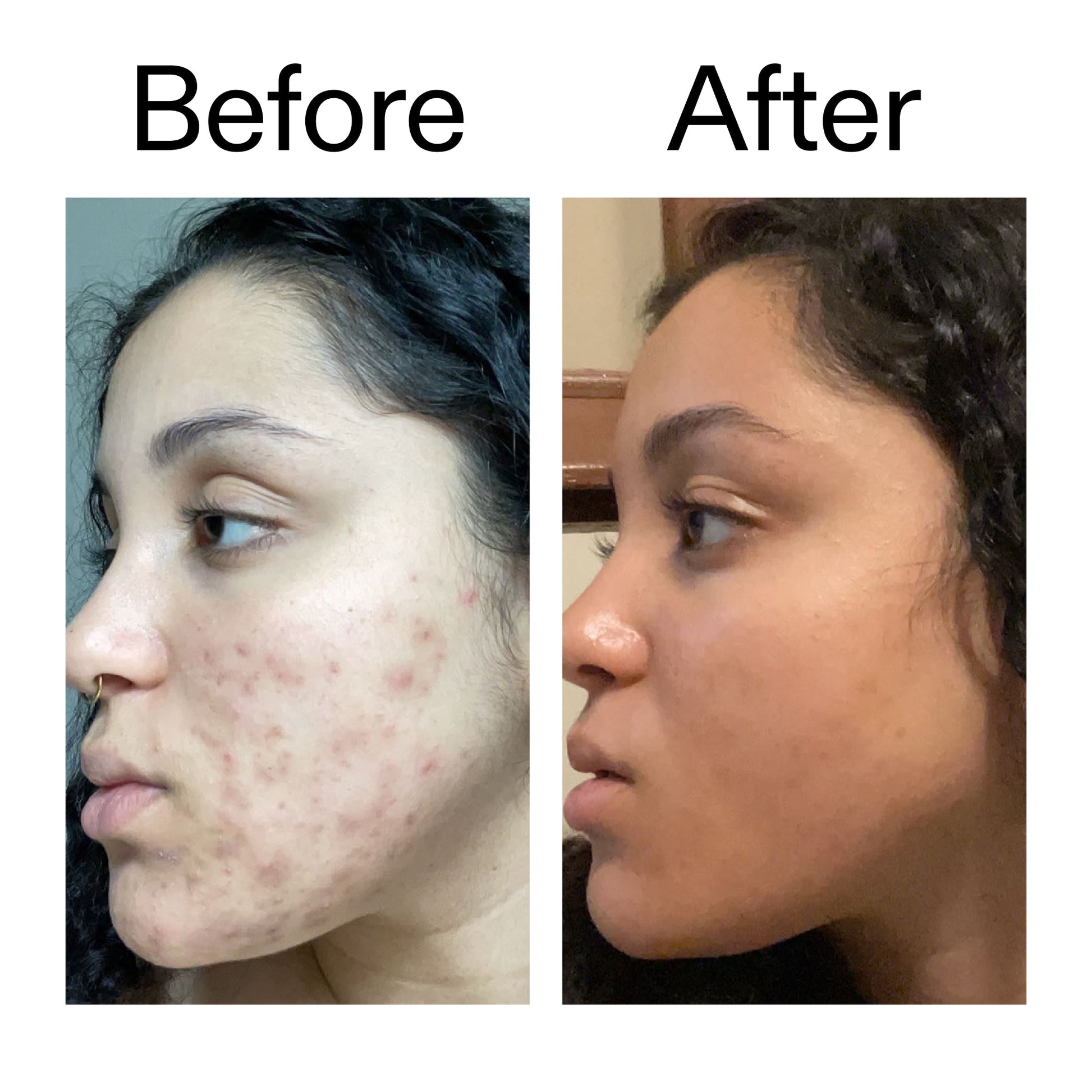 tranexamic-acid-serum-o9 Tranexamic_Acid_Serum_Before_After_2000x2000_98ebc8be-77b0-4843-8a22-90790ebe918b.jpg